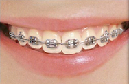 Metal Braces