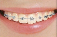 Self Lingual Braces